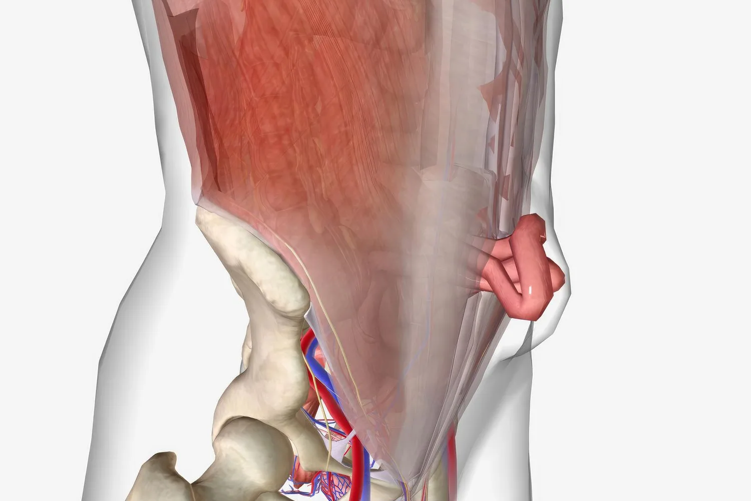 Hernia inguinal